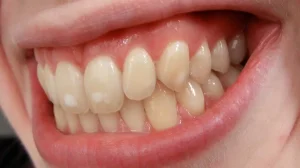 Las mejores maneras de reducir las manchas blancas de los dientes mientras usa aparatos ortopédicos - Webb Orthodontics