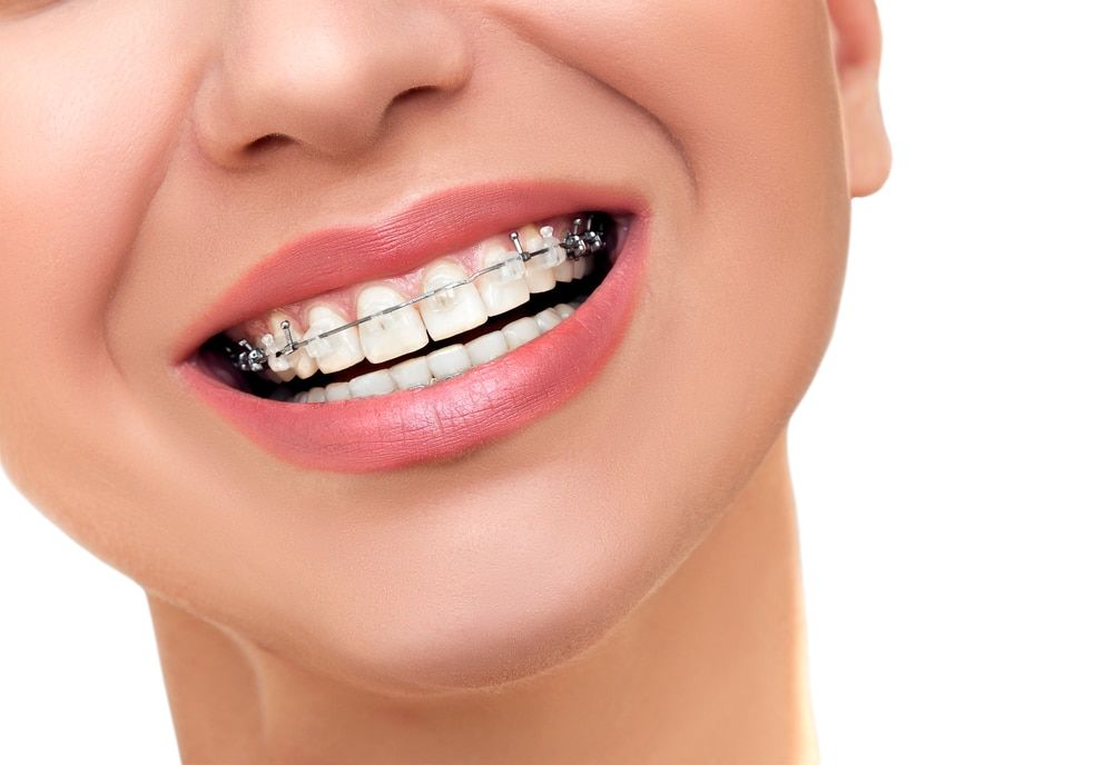 opciones de blanqueamiento dental frenos