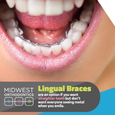 Midwest Orthodontics Center - Frenos linguales para dientes más rectos