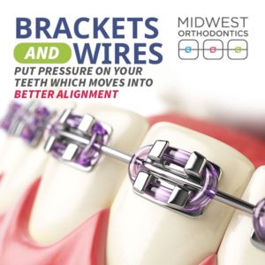 ¿Por qué necesito que me ajusten los frenos?  - los brackets y los alambres ejercen presión sobre los dientes - centro de ortodoncia del medio oeste