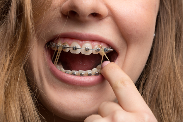 Una foto de una niña mostrando sus elásticos Interarch