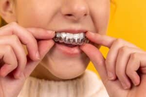 Trabajo Invisalign para niños.