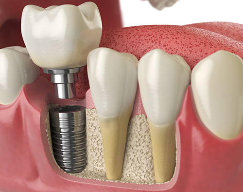 implantes dentales