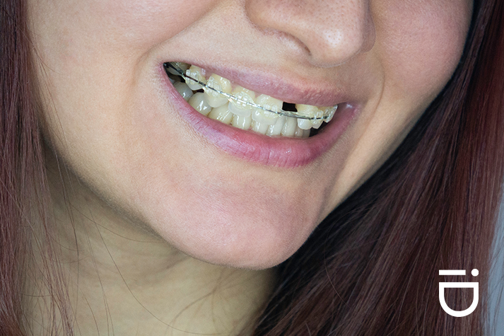 frenos con dientes faltantes